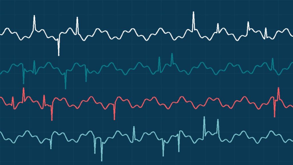 Çankaya ve Kızılay'da EEG ve EMG