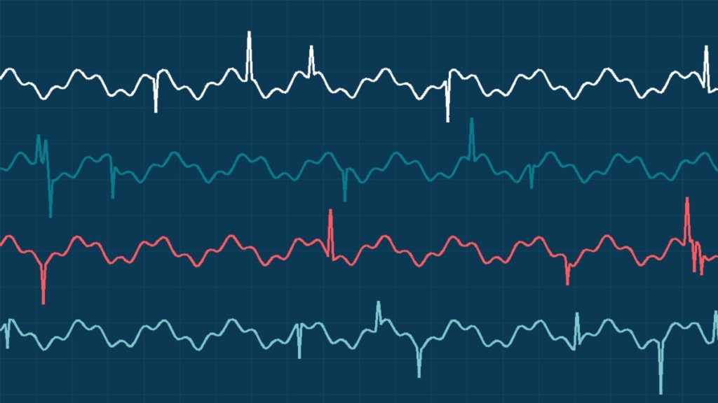 EMG Nedir? Sinir ve Kas Testi