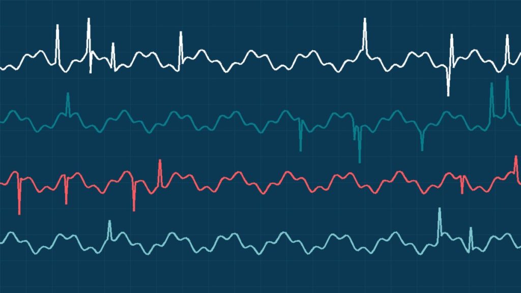 Epilepsi ve EEG: Tanı ve Takipte Rolü